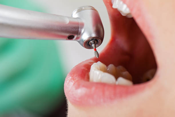 Best Broken or Cracked Tooth Emergency Dentist in Ashville, OH